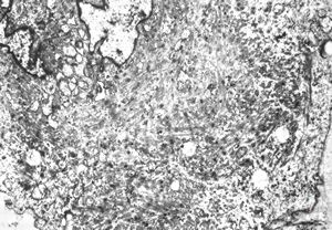 M,29y. | testis - embryonal rhabdomyosarcoma in teratoma M,29y. | testis - embryonal rhabdomyosarcoma in teratoma